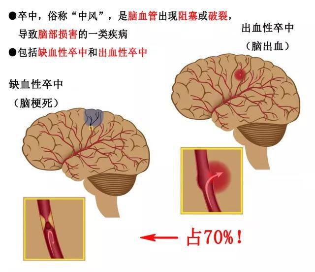 大幅降温一定要警惕卒中