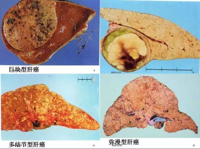 重庆男子狂奔9小时逃出缅北